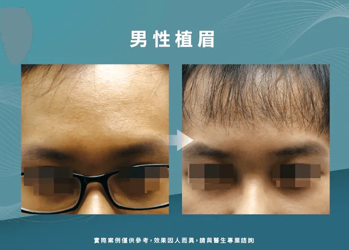 男性植眉見證-台南植眉推薦