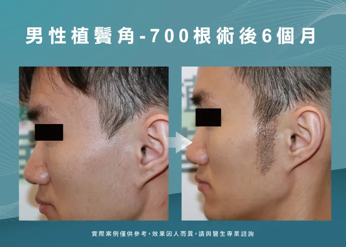 男性植鬢角6個月成果-台南植鬢角推薦