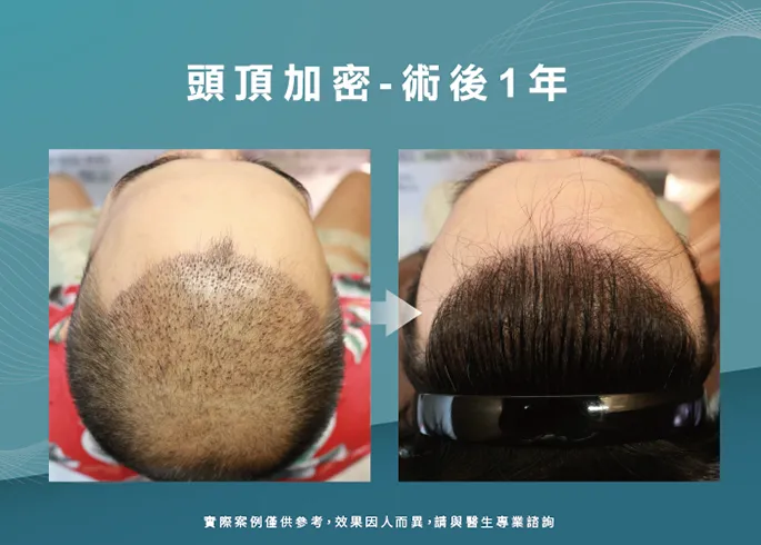 男性頭頂加密1年效果-台南植髮推薦