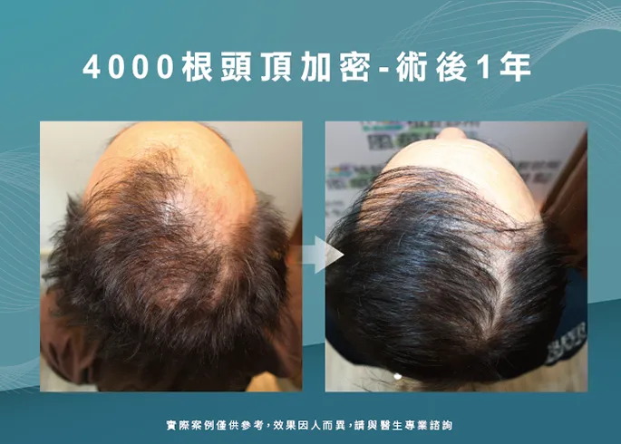 男性頭頂部加密植髮-台南植髮推薦
