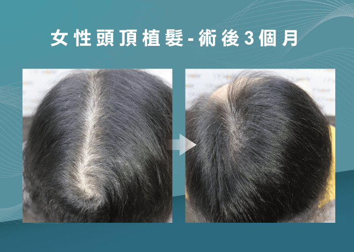 女性頭頂植髮3個月見證-台南頭頂植髮推薦