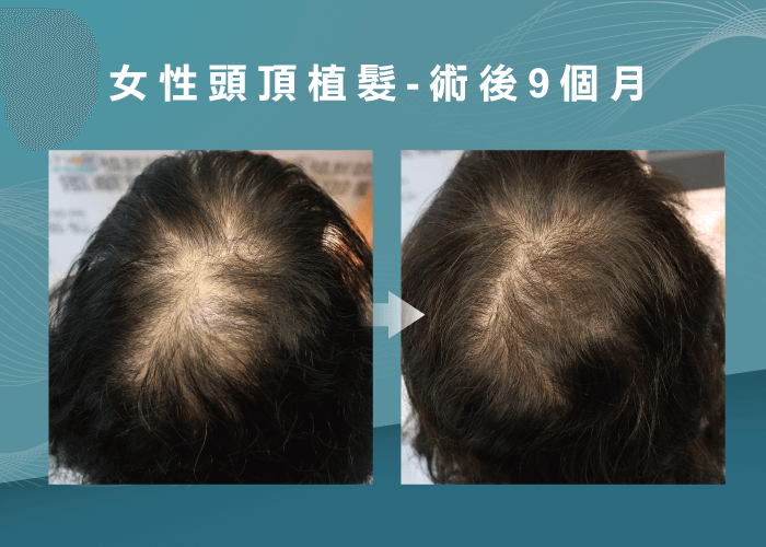 女性頭頂植髮9個月真實見證-台南頭頂植髮推薦