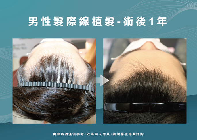 男性髮際線植髮術後1年-台南植髮際線