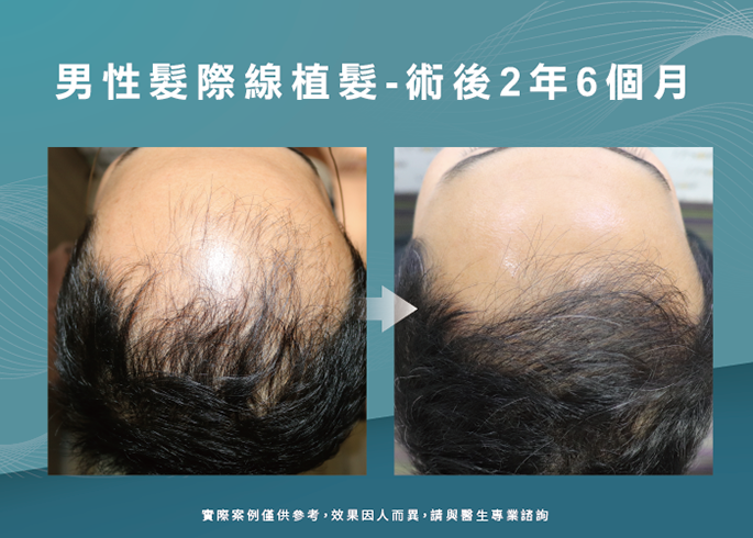 男性髮際線植髮術後2年6個月-台南植髮際線