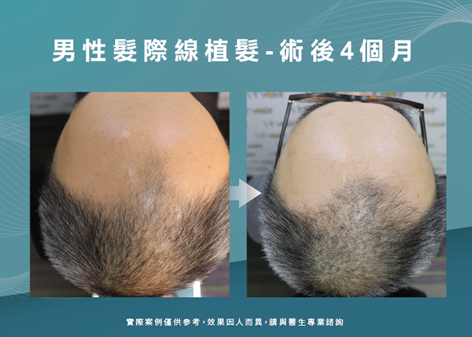 男性髮際線植髮術後4個月-台南植髮際線