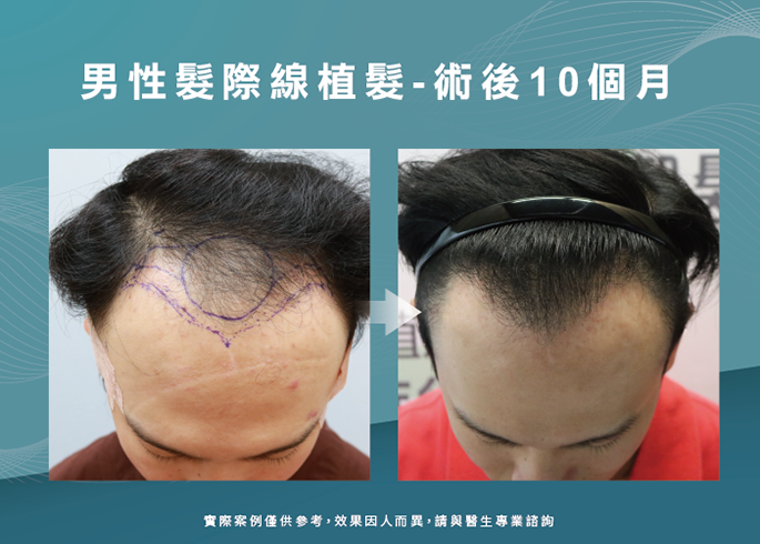 男性髮際線植髮術後10個月-台南植髮際線