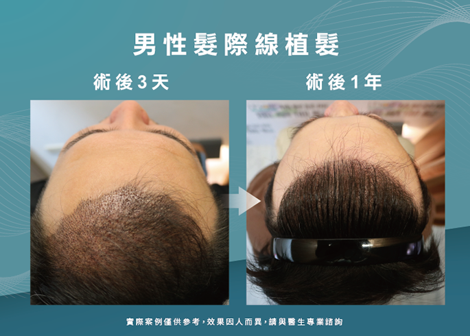 男性髮際線植髮術後3天與1年-台南植髮際線