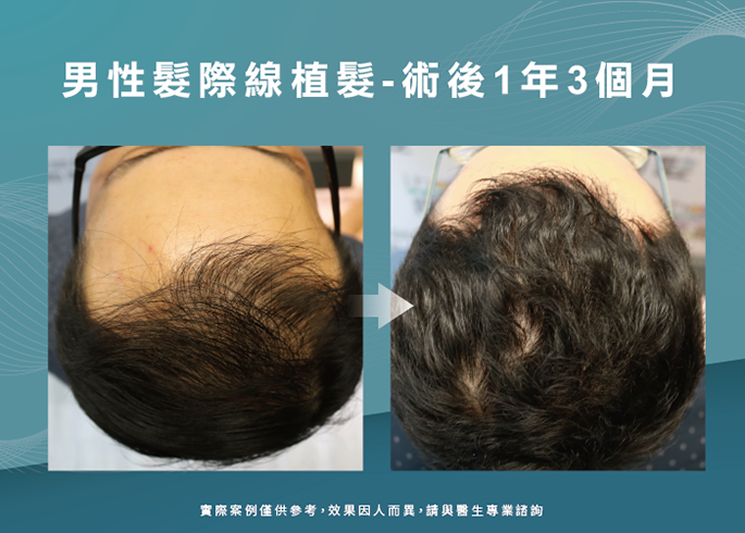 男性髮際線植髮術後1年3個月-台南植髮際線