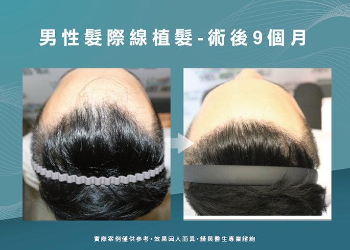 男性髮際線植髮術後9個月-台南植髮際線