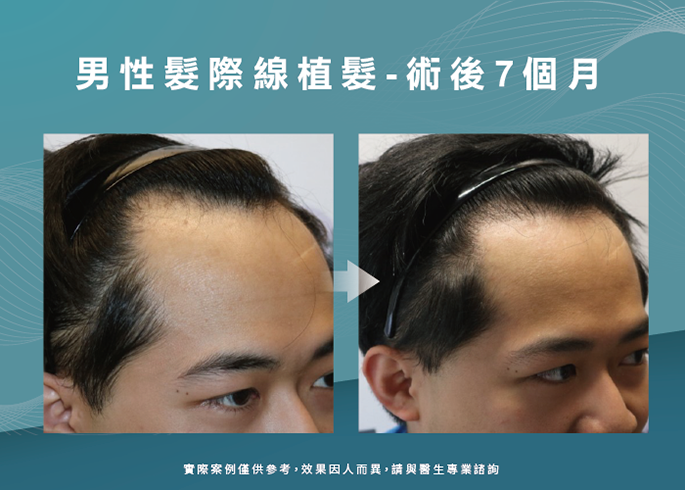 男性髮際線植髮術後7個月-台南植髮際線