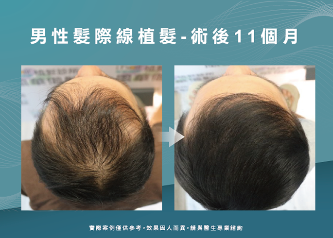 男性髮際線植髮術後11個月-台南植髮際線