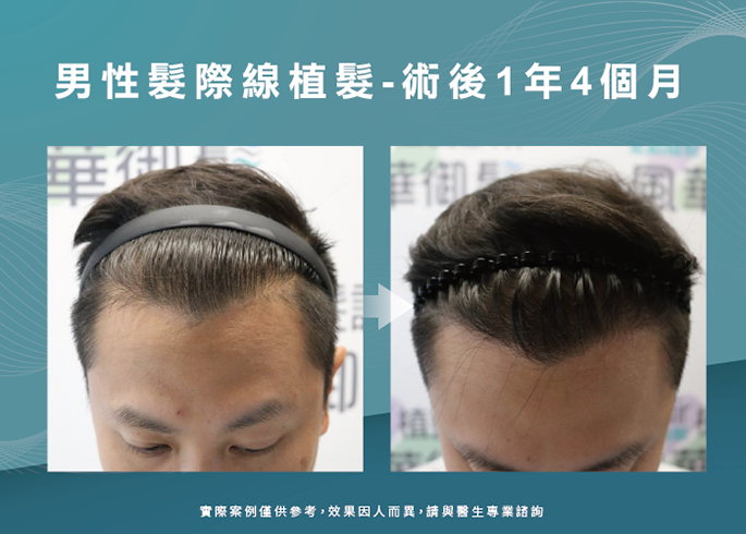 男性髮際線植髮術後1年4個月-台南植髮際線