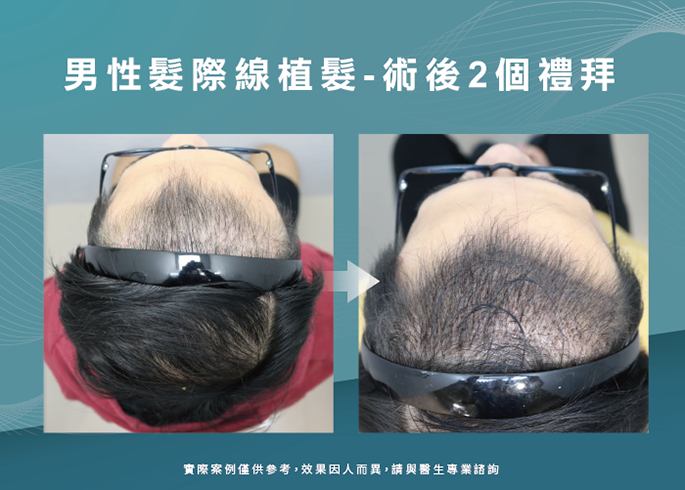 男性髮際線植髮術後2個禮拜-台南植髮際線