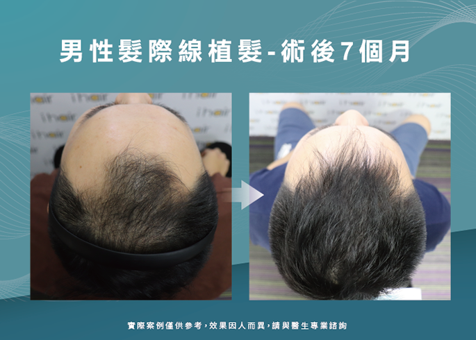男性髮際線植髮術後7個月-台南植髮際線