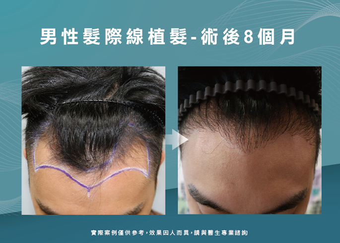 男性髮際線植髮術後8個月-台南植髮際線