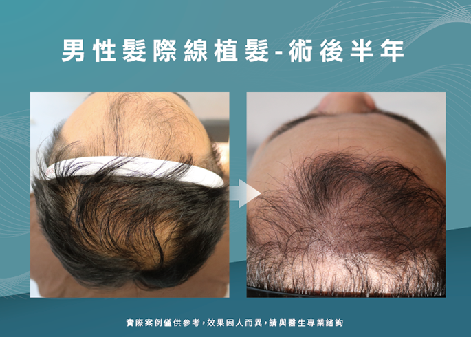 男性髮際線植髮術後6個月-台南植髮際線