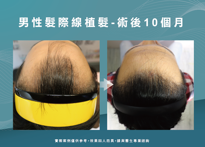 男性髮際線植髮術後10個月-台南植髮際線