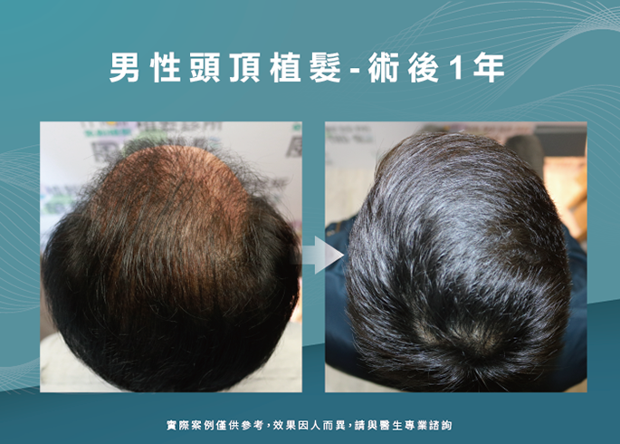 男性頭頂部植髮1年效果-台南植髮推薦