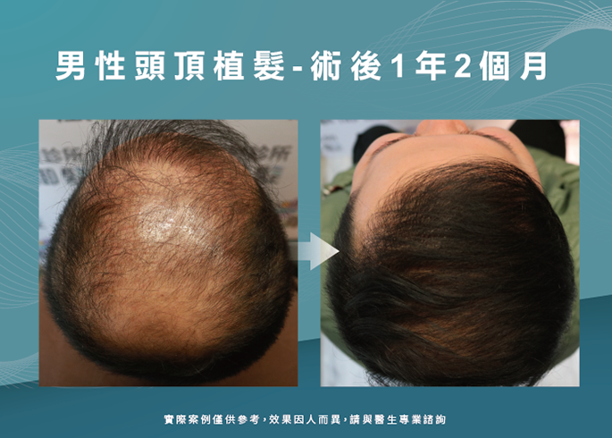 男性頭頂植髮1年2個月效果-台南植髮推薦