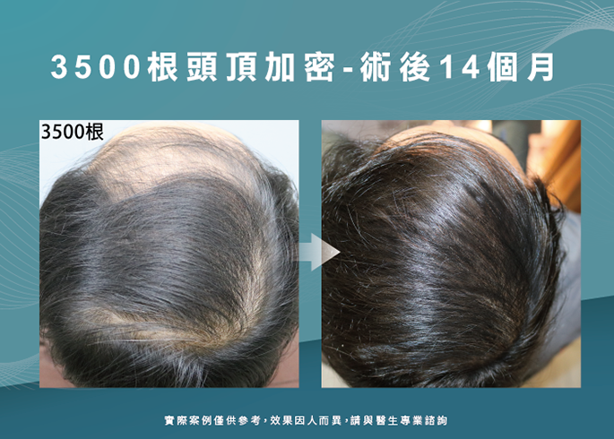 男性頭頂加密14個月效果-台南植髮推薦