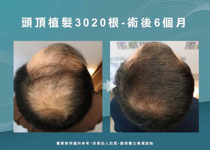 男性頭頂部植髮6個月效果-台南植髮推薦