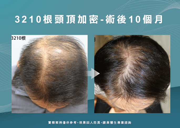 男性頭頂植髮10個月效果-台南植髮推薦