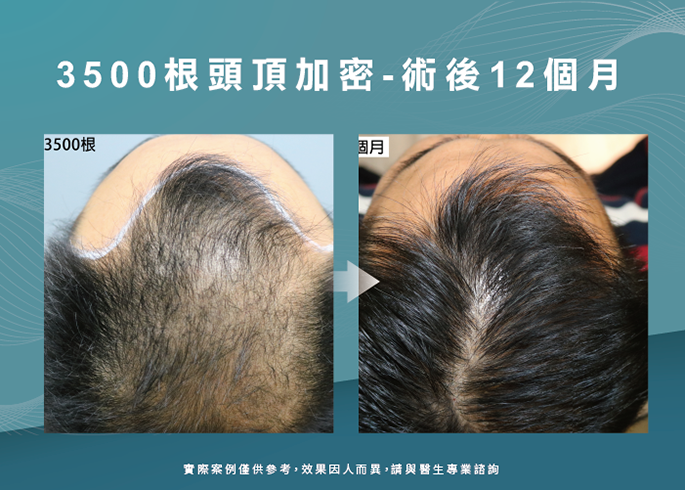 男性頭頂植髮12個月效果-台南植髮推薦