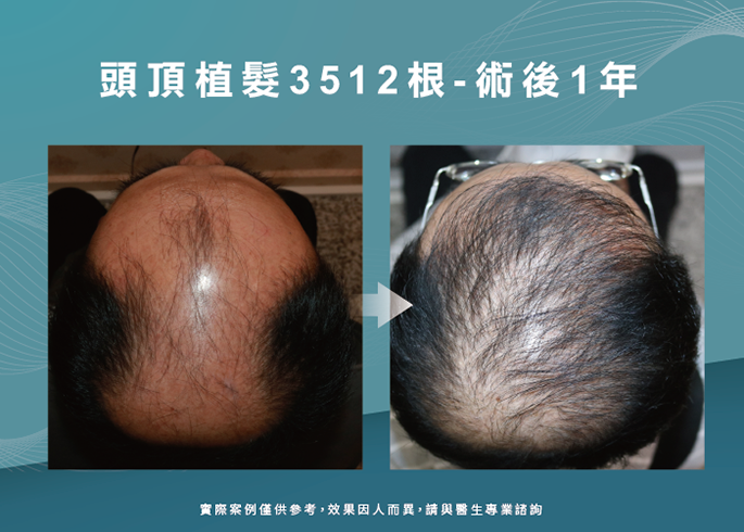 男性頭頂植髮3512根-台南植髮推薦