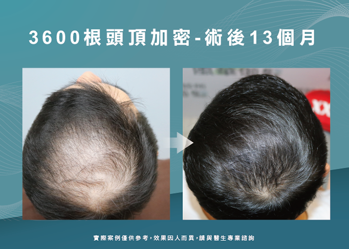 男性頭頂部植髮13個月效果-台南植髮推薦