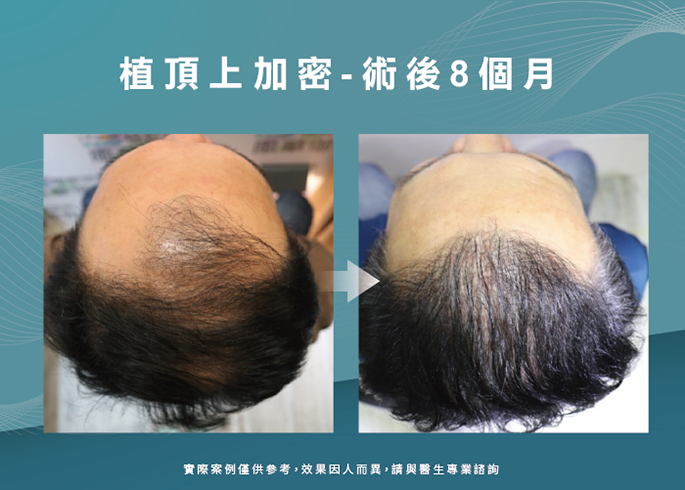 男性頭頂部植髮8個月-台南植髮推薦
