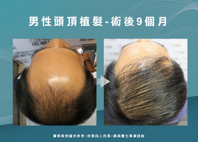 男性頭頂部植髮9個月效果-台南植髮推薦