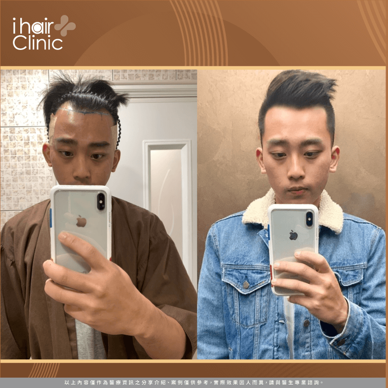 Ｍ型禿植髮流程-台南植髮推薦