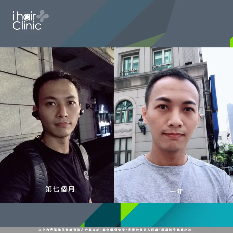 M形禿植髮生長期成效明顯-台南植M型禿