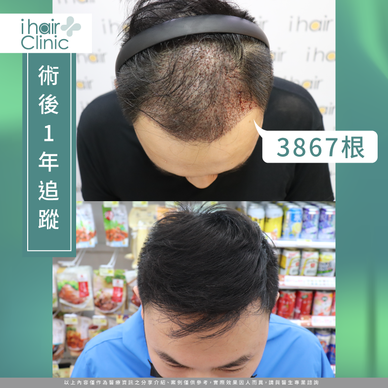 術後1年追蹤成效-台南植髮診所推薦