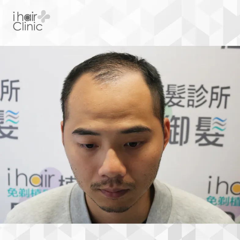 T先生雄性禿狀況-台南植髮推薦