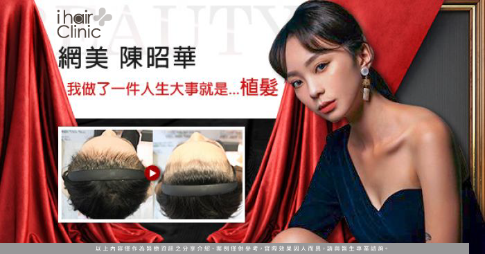 女性植髮際線-台北女性植髮推薦