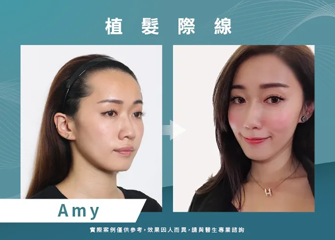 女性髮際線植髮-美型髮際線