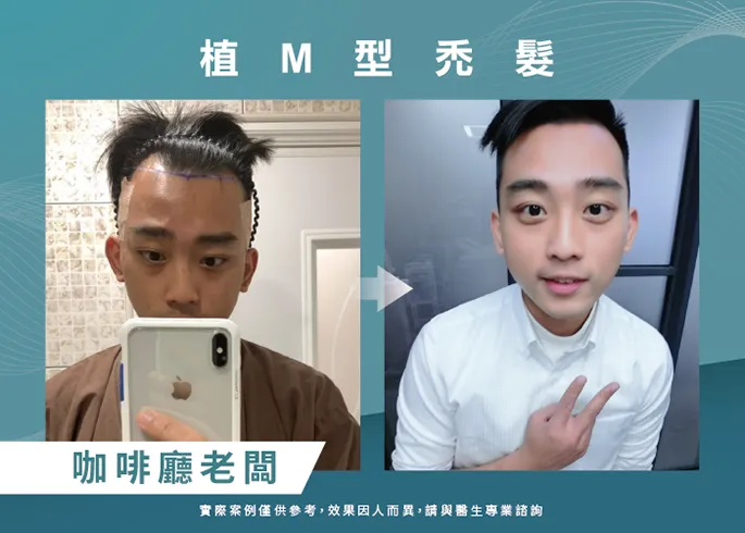 咖啡廳老闆男性髮際線植髮-台北植髮際線