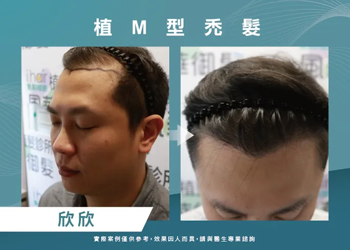 素人欣欣男性髮際線植髮-台北植髮際線