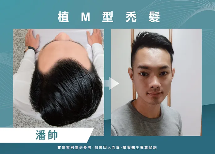 潘帥男性髮際線植髮-台北植髮際線