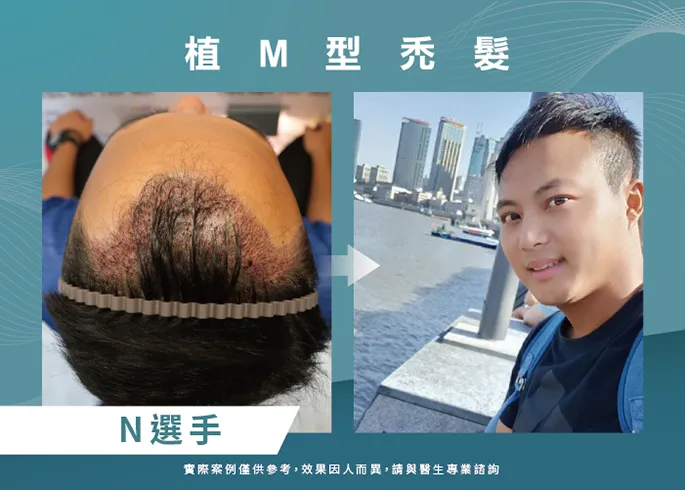 N選手男性髮際線植髮-台北植髮際線