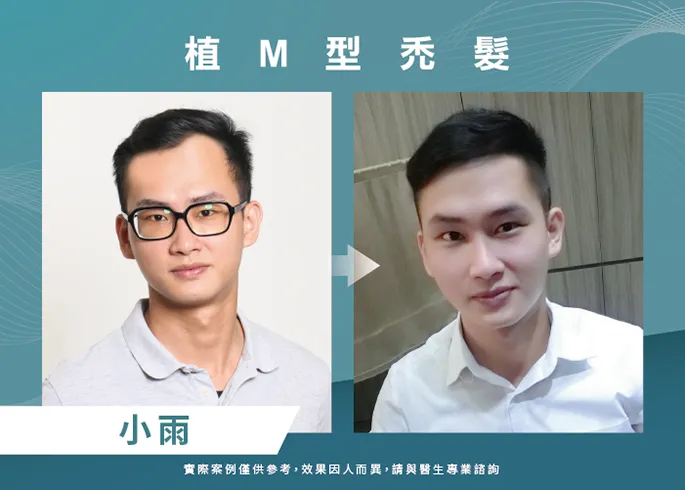 小雨男性髮際線植髮-台北植髮際線