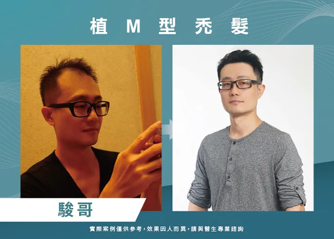 駿哥男性髮際線植髮-台北植髮際線