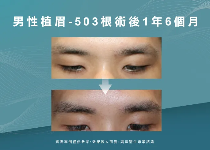 男性植眉1年6個月-台北植眉推薦