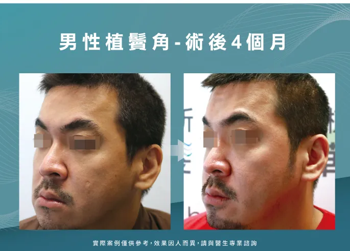 男性植鬢角見證-台北植鬢角推薦