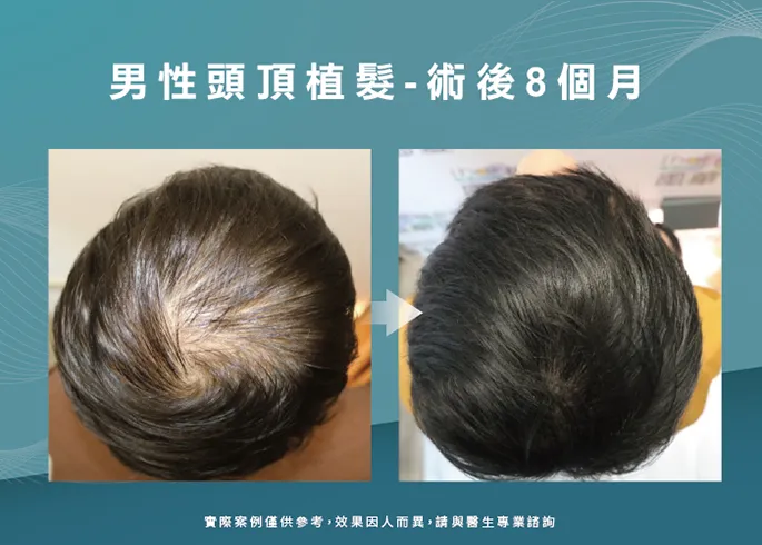 男性頭頂部植髮8個月效果-台北植髮推薦
