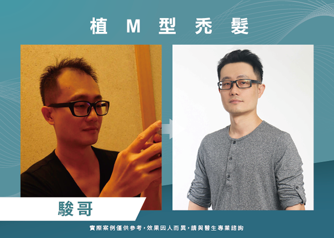駿哥男性髮際線植髮-台北植髮際線
