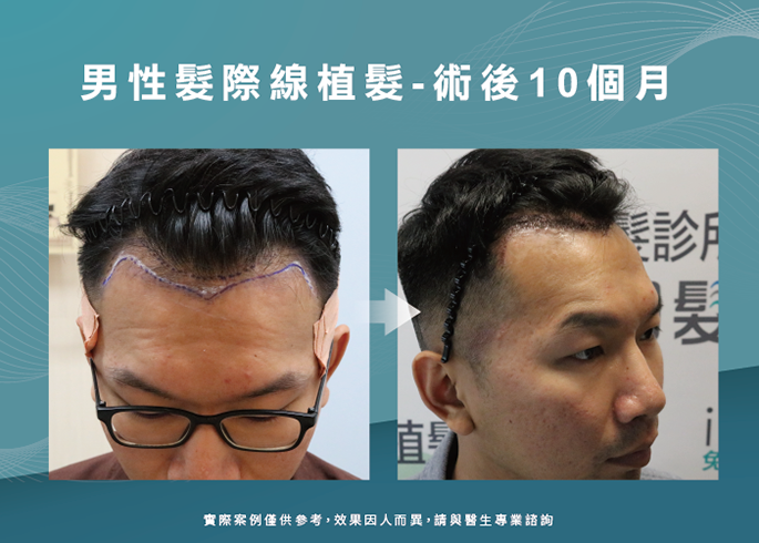 男性髮際線植髮術後10個月-台北植髮際線