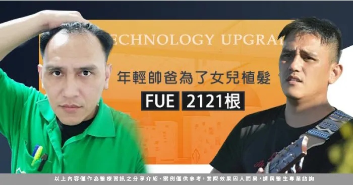 F先生M型禿植髮-台北植髮推薦