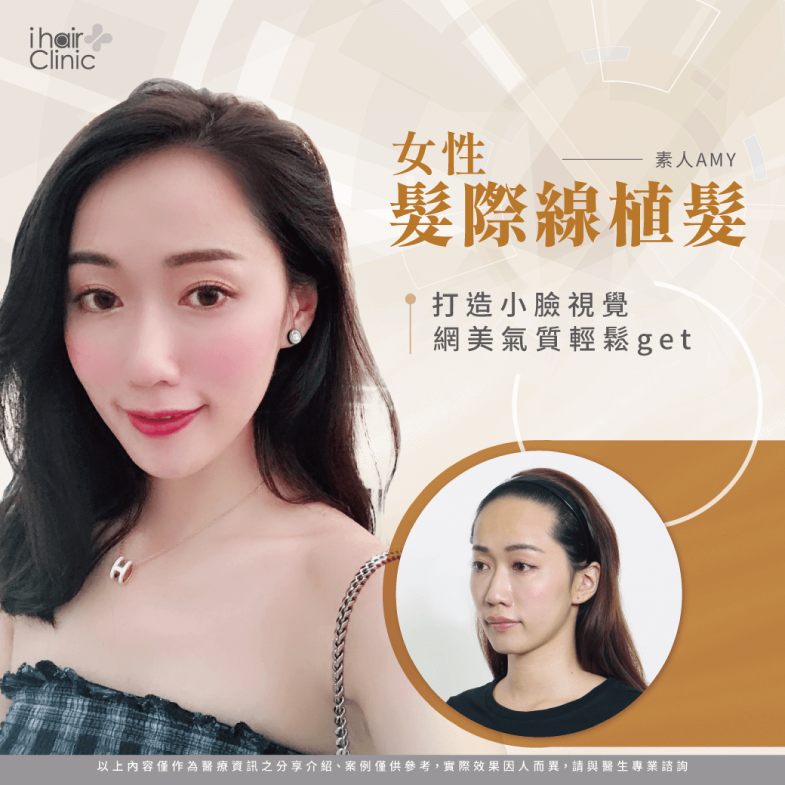 素人美人amy 小臉植髮際線 Ihair風華御髮 素人美人amy 小臉植髮際線 Ihair風華御髮